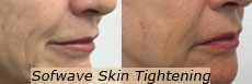 Sofwave NYC and Sofwave Skin Tightening New York, NY - Ron Shelton M.D.