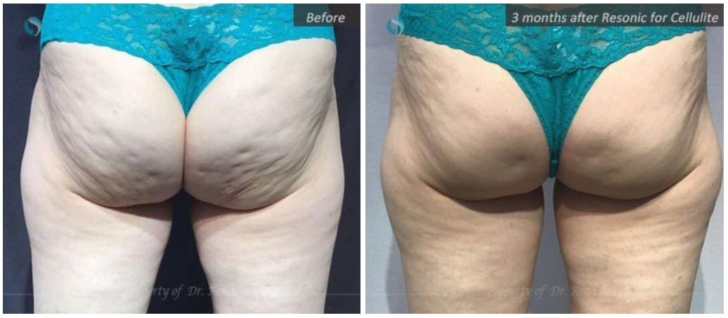 resonic cellulite reduction in nyc