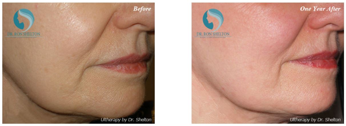 New York Ultherapy Therapy and Non-invasive skin tightening & lifting NY