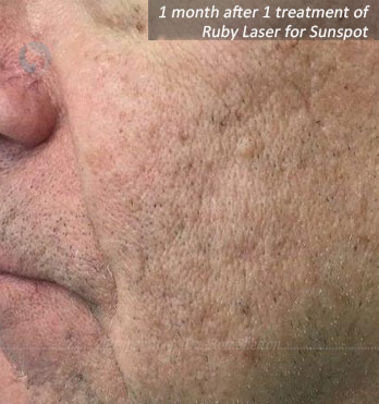 1 month after 1 treatment of Ruby Laser to eradicate Sunspot (lentigo)