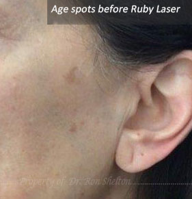Before Ruby Laser treatment age spots are visible