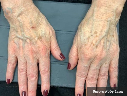 age spots before ruby laser