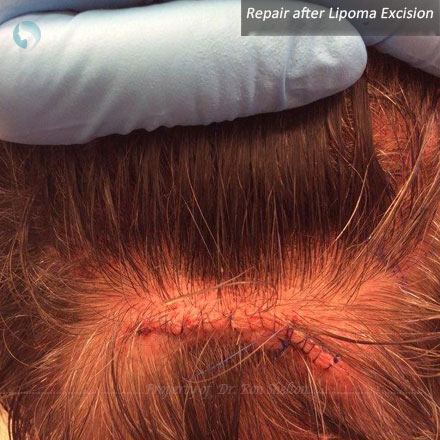 Repair after Lipoma Excision