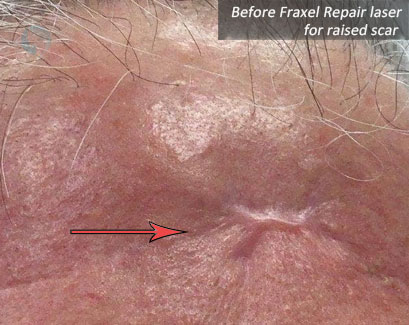 Before Fraxel laser for raised scar