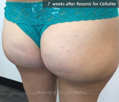 7 weeks after Resonic for cellulite