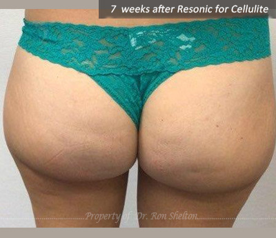 7 weeks after Resonic for cellulite