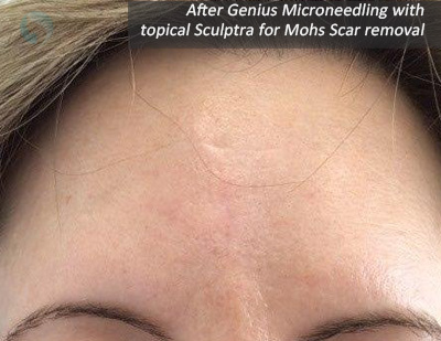 After Genius Microneedling with topical Sculptra for Mohs Scar removal