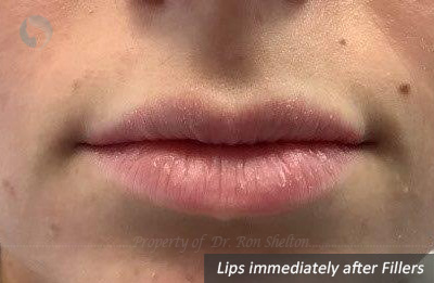 Lips immediately after fillers