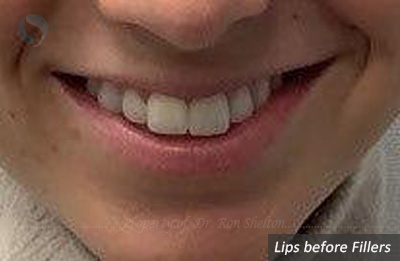 Lips before fillers