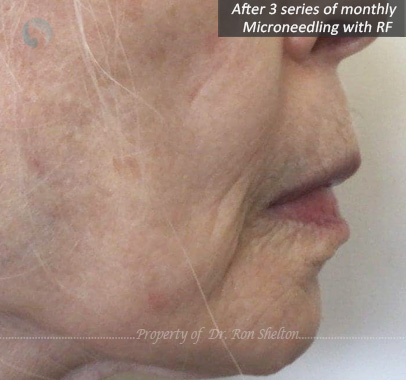 After series of 3 monthly Microneedling with RF
