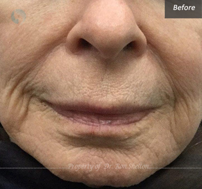 Before Microneedling with RF