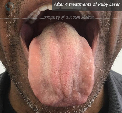 After 4 Ruby laser treatments