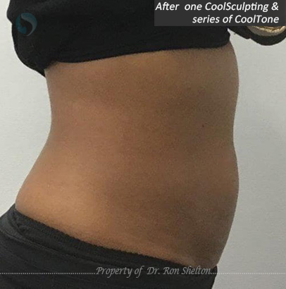 After one Coolsculpting and a series of CoolTone treatments