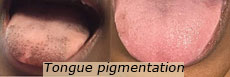 tongue pigmentation nyc