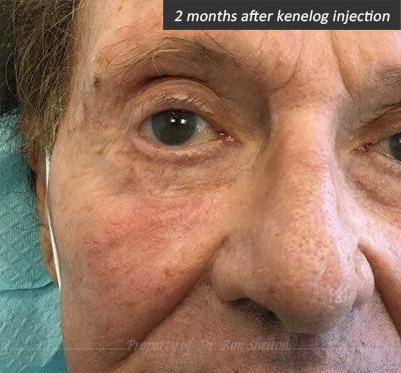 2 Months after kenelog injection for scar revision