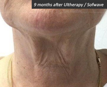 9 months after ultherapy / sofwave done together