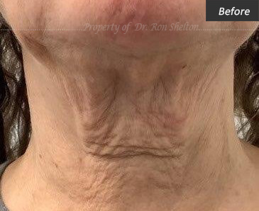 Before neck tightening with sofwave