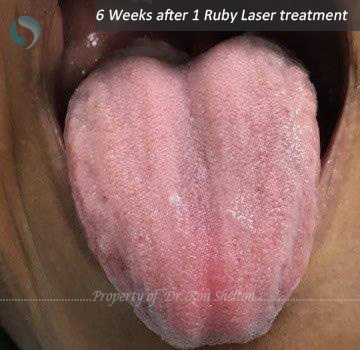 6 Weeks after 1 Ruby Laser treatment