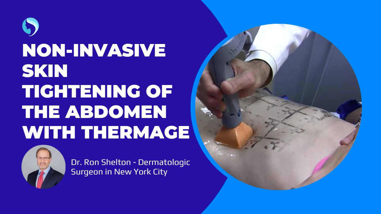 Thermage for Abdomen loose skin