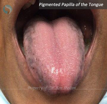 Pigmented Papilla of the Tongue