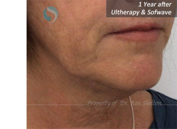 1 Year after Ultherapy & Sofwave