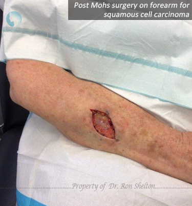 Post Mohs surgery on forearm for squamous cell carcinoma