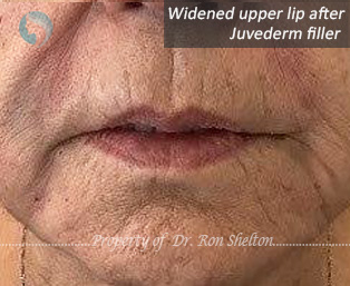Widened upper lip after Juvederm filler