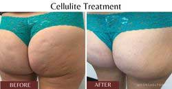 cellulite-treatment