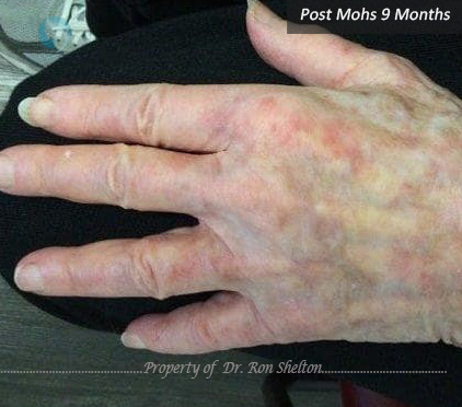 Imperceptible scar hand after 9 months