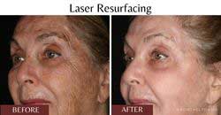 laser-resurfacing