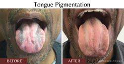 tongue-pigmentation