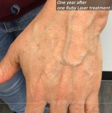 One year after one Ruby Laser treatment