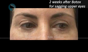 2 weeks after Non surgical Botox Brow lift.