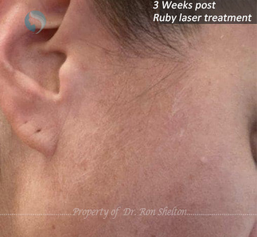 3 weeks post ruby laser treatment