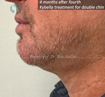 4 months after 4th Kybella treatment
