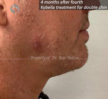 4 months after 4th Kybella treatment