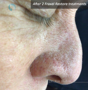 After 2 Fraxel 1550nm treatment for scar after Mohs surgery