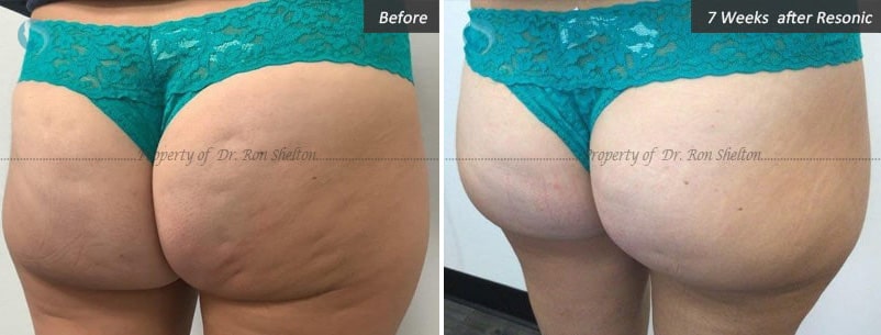 Cellulite treatment NYC