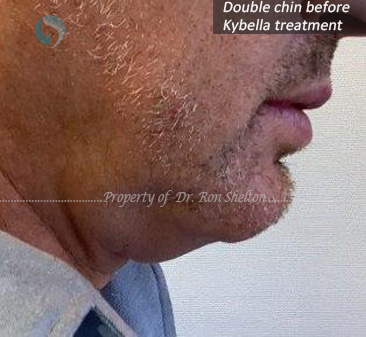 Double chin before Kybella
