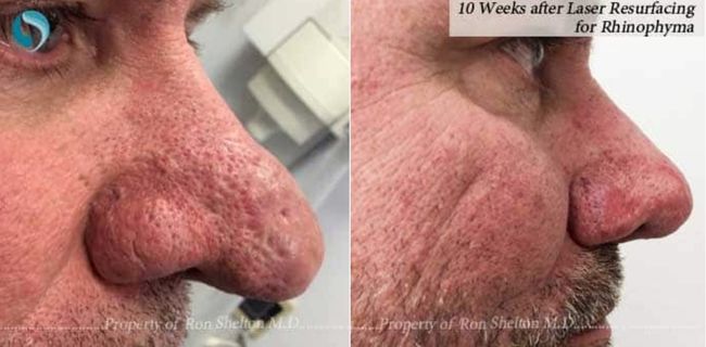 Before and 10 Weeks after Laser Resurfacing of Rhinophyma