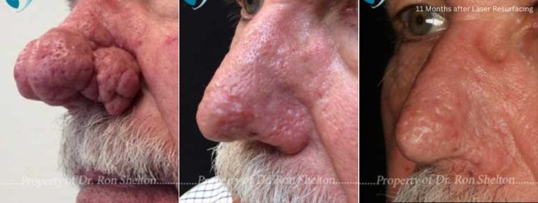 Before, 3 Months after and 11 Months after Laser Resurfacing for Rhinophyma