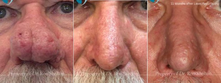 Before, 3 Months after and 11 Months after Laser Resurfacing for Rhinophyma