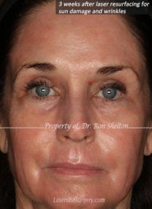 Only 3 weeks post fully ablative erbium laser (Sciton Contour), full face. Laser resurfacing for sun damage wrinkles etc.