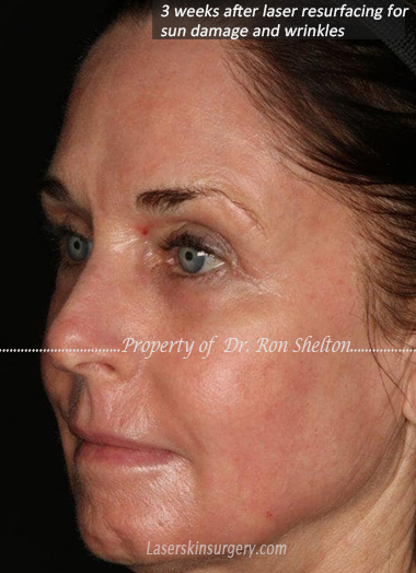 Only 3 weeks post fully ablative erbium laser (Sciton Contour), full face. Laser resurfacing for sun damage wrinkles etc.
