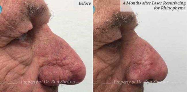Before and 4 Months after Laser Resurfacing for Rhinophyma