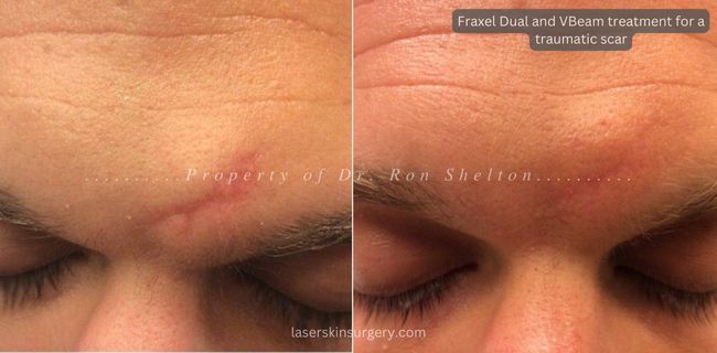 Fraxel Dual and VBeam treatment for a traumatic scar