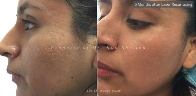 5 Months after Two treatments with Fraxel Restore/Dual laser and one Permea for Acne Scars