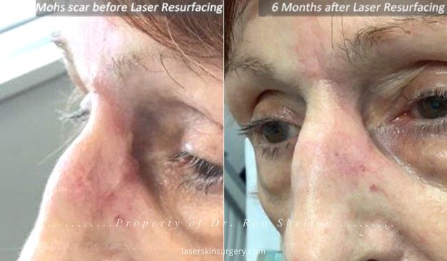 Mohs scar before laser resurfacing and 6 months after pulsed dye and erbium ablative laser resurfacing