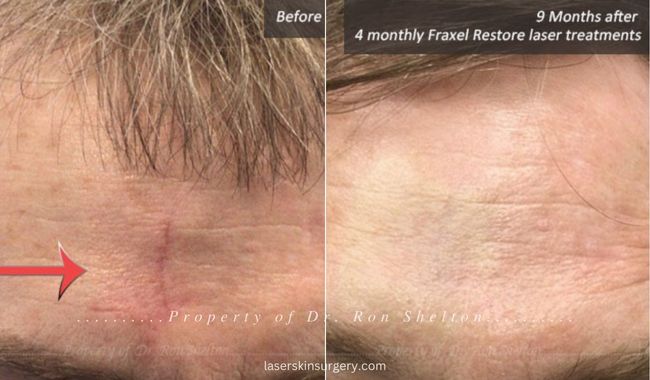 Scar before Laser Resurfacing and 9 Months after 4 Monthly Fraxel Restore laser treatments
