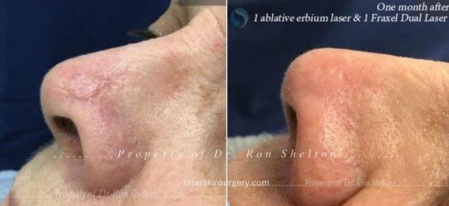 1 ablative erbium laser and one month after 1 Fraxel Dual laser